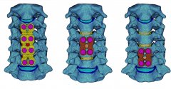 颈椎人工椎间盘置换的三维有限元分析
