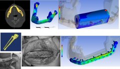 下颌骨体部缺损腓骨重建有限元分析