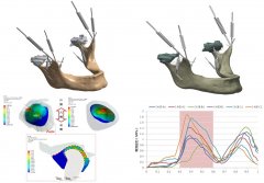 颞下颌关节有限元分析